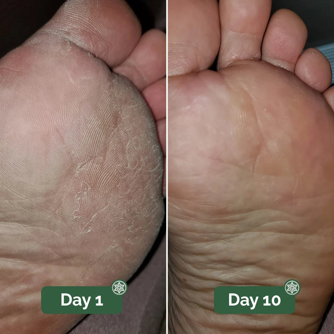 Sebriva Antifungal Soap®